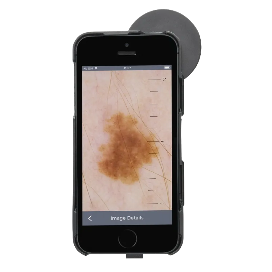 Image dermoscopique sur iPhone avec le HEINE iC1